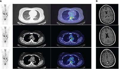 Case report: EML4::NTRK3 gene fusion in a patient with metastatic lung adenocarcinoma successfully treated with entrectinib